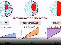 Thrombectomy in acute stroke