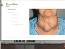 Thyroid Gland - Head and Neck Anatomy Thyroid Gland - Head and Neck Anatomy