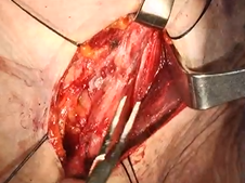 Thyroid lobectomy