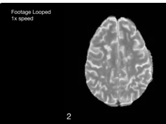 Time-lapse MRI From a Patient With MS and Expanding Rim Lesions Time-lapse MRI From a Patient With MS and Expanding Rim Lesions