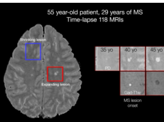 Time-lapse MRI From a Patient With MS Showing an Expanding Rim+ and a Shrinking Rim? Lesion Time-lapse MRI From a Patient With MS Showing an Expanding Rim+ and a Shrinking Rim? Lesion