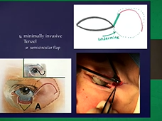 Tips for Eyelid Reconstruction