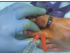 toe nail infection and pus drainage