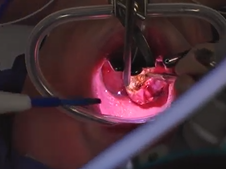 Tonsillectomy and Adenoidectomy using Electrocautery Technique