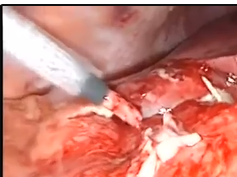 Toothpick Perforation Of The Duodenum