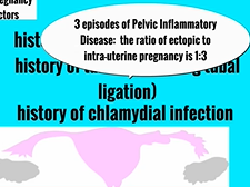 Topic 15: Ectopic Pregnancy
