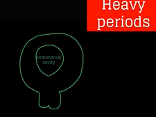 Topic 53: Uterine Leiomyoma