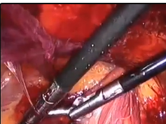 Totally Extra-Peritoneal Repair With Rebound Hernia Repair Device