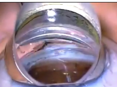 Trabectome Ab Interno Trabeculectomy in a Prepared Cadaver Eye Trabectome Ab Interno Trabeculectomy in a Prepared Cadaver Eye