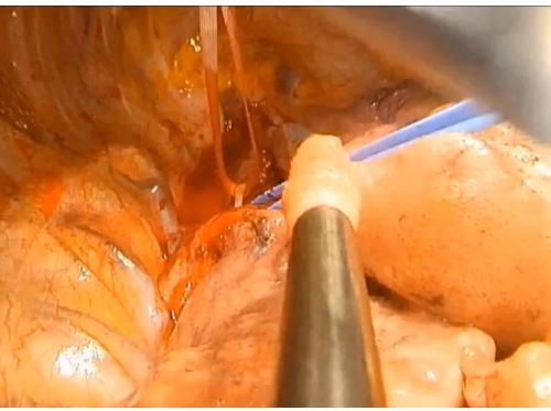 Reconstruction trachéo-bronchique avec réimplantation de la bronche principale droite Reconstruction trachéo-bronchique avec réimplantation de la bronche principale droite