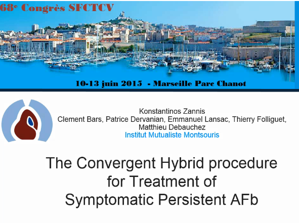 Traitement de la fibrillation atriale persistante avec une nouvelle stratégie hybride Traitement de la fibrillation atriale persistante avec une nouvelle stratégie hybride