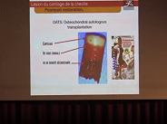 Traitement des Lésions Ostéochondrales du Dôme Astragalien (LODA)
