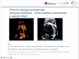 Traitement in utero des valvulopathies Traitement in utero des valvulopathies