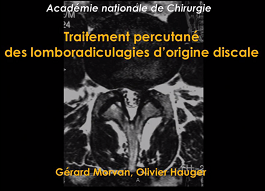 Traitement percutané des lomboradiculalgies d'origine discale