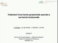 Traitement prolapsus sur stomie associé à une éventration