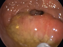 Trans-anal minimally invasive surgical approach to removal of a large rectal polyp Trans-anal minimally invasive surgical approach to removal of a large rectal polyp