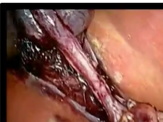 Trans-Cystic Duct Lcbde Using Balloon Dilation, Video Choledochoscope, Mig, And Nitinol Stone Basket Trans-Cystic Duct Lcbde Using Balloon Dilation, Video Choledochoscope, Mig, And Nitinol Stone Basket