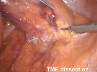 Transanal and Robotic TME (robotic assisted TaTME) using Senhance Robotic System Transanal and Robotic TME (robotic assisted TaTME) using Senhance Robotic System
