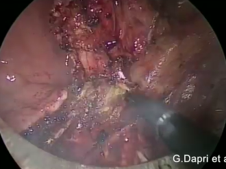 Transanal Endolaparoscopic T2N0M0 Low Rectal Adenocarcinoma Resection followed by Adjuvant Therapy Transanal Endolaparoscopic T2N0M0 Low Rectal Adenocarcinoma Resection followed by Adjuvant Therapy