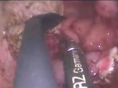 Transanal Endoscopic Operation (TEO) for Rectal Carpet Lesion