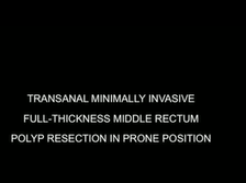 Transanal Minimally Invasive Full-Thickness Anterior Middle Rectum Polyp Resection Transanal Minimally Invasive Full-Thickness Anterior Middle Rectum Polyp Resection
