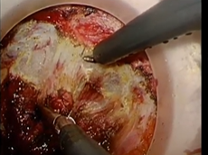 Transanal TME with Retroileal-Colorectal Anastomosis: Combining Old & New Techniques Transanal TME with Retroileal-Colorectal Anastomosis: Combining Old & New Techniques