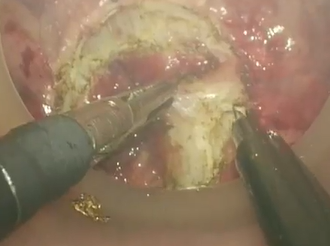 Transanal Total Mesorectal Excision: A Method To Facilitate Dissection in One-Team Approach Transanal Total Mesorectal Excision: A Method To Facilitate Dissection in One-Team Approach