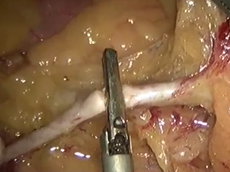 Transanal Total Mesorectal Excision with D3 Para-aortic Lymph Node Dissection for Low Rectal Cancer Transanal Total Mesorectal Excision with D3 Para-aortic Lymph Node Dissection for Low Rectal Cancer