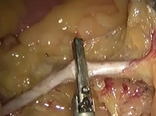 Transanal Total Mesorectal Excision with D3 Para-aortic Lymph Node Dissection for Low Rectal Cancer Transanal Total Mesorectal Excision with D3 Para-aortic Lymph Node Dissection for Low Rectal Cancer