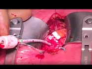 Transaortic transcatheter aortic valve replacement through a right minithoracotomy Transaortic transcatheter aortic valve replacement through a right minithoracotomy