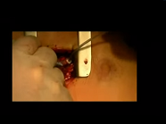 Transapical neochord implantation