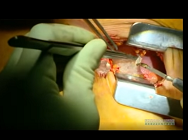 Transapical transcatheter off-pump aortic valve implantation