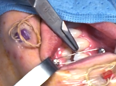 Transcervical Exploration of Parapharynx for Deep Lobe Parotid Pleomorphic Adenoma Transcervical Exploration of Parapharynx for Deep Lobe Parotid Pleomorphic Adenoma