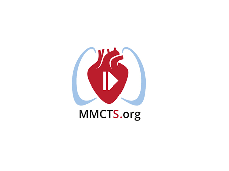 Transcervical-subxiphoid-VATS maximal thymectomy for myasthenia gravis Transcervical-subxiphoid-VATS maximal thymectomy for myasthenia gravis