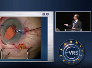 Transconjunctival Intrasceral IOL Fixation with a Modified Double-needle Technique Transconjunctival Intrasceral IOL Fixation with a Modified Double-needle Technique