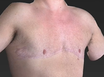 Transgender Mastectomy: Plastic Surgery Hot Topics