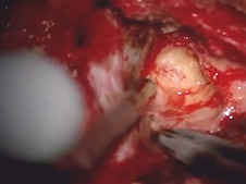 Translabyrinthine approach for vestibular schwannoma