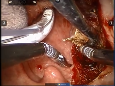 Transoral Robotic-Assisted Surgery (TORS) Tonsillectomy