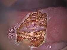 Transoral Zenker's diverticulotomy