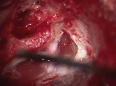 Transotic approach for large meningioma
