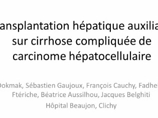 Transplantation hépatique auxiliaire sur cirrhose compliquée de carcinome hépatocellulaire Transplantation hépatique auxiliaire sur cirrhose compliquée de carcinome hépatocellulaire