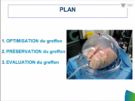 Transplantation Pulmonaire: donneurs et receveurs marginaux : de l'intérêt de la perfusion ex-vivo. Transplantation Pulmonaire: donneurs et receveurs marginaux : de l'intérêt de la perfusion ex-vivo.