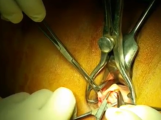 Transvaginal Repair for Anterior Rectocele