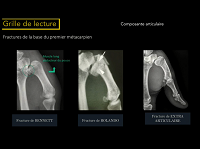 Traumatismes des membres