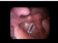 Treating Vocal Cord Scarring Structural Response - 2