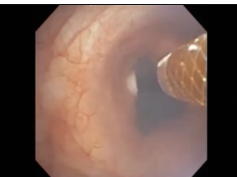 Treatment of Benign Tracheal Stenosis Using Spray Cryotherapy