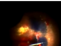 Treatment of Proliferative Diabetic Retinopathy Using Viscosurgery With Vital Dye Treatment of Proliferative Diabetic Retinopathy Using Viscosurgery With Vital Dye