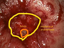 Treatment of Rectovaginal Post-anastomotic fistula with Transanal endoscopic operation (TEO) Treatment of Rectovaginal Post-anastomotic fistula with Transanal endoscopic operation (TEO)