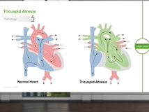 Tricuspid Atresia - Pediatric Cardiology