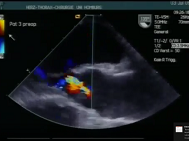 Tricuspidization of the quadricuspid aortic valve